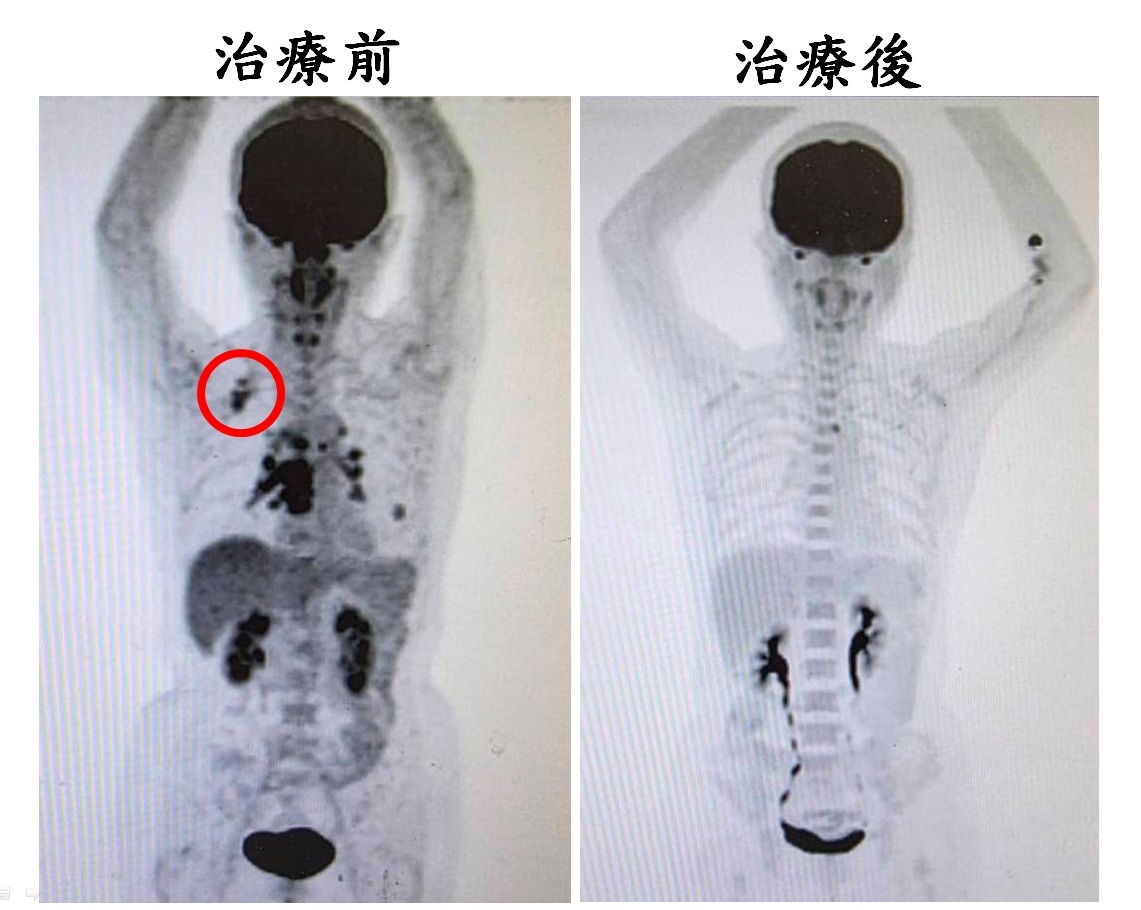 個案經檢查發現，癌細胞轉移至右頸淋巴結紅圈處，所幸接受ADC藥物治療後，病情獲得穩定控制。