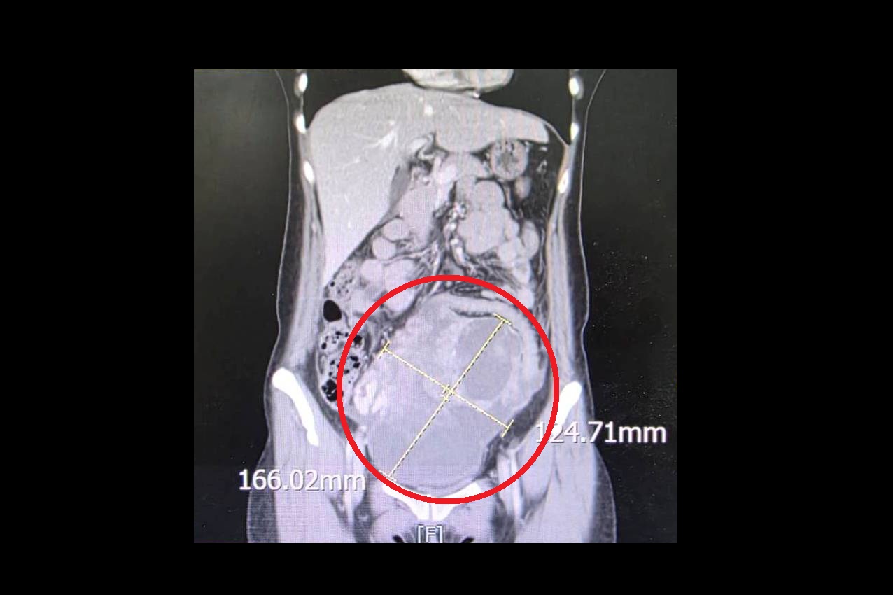病人就醫發現腹部直徑高達16公分的巨大腫瘤紅圈處，病理報告為罕見的同步性子宮內膜