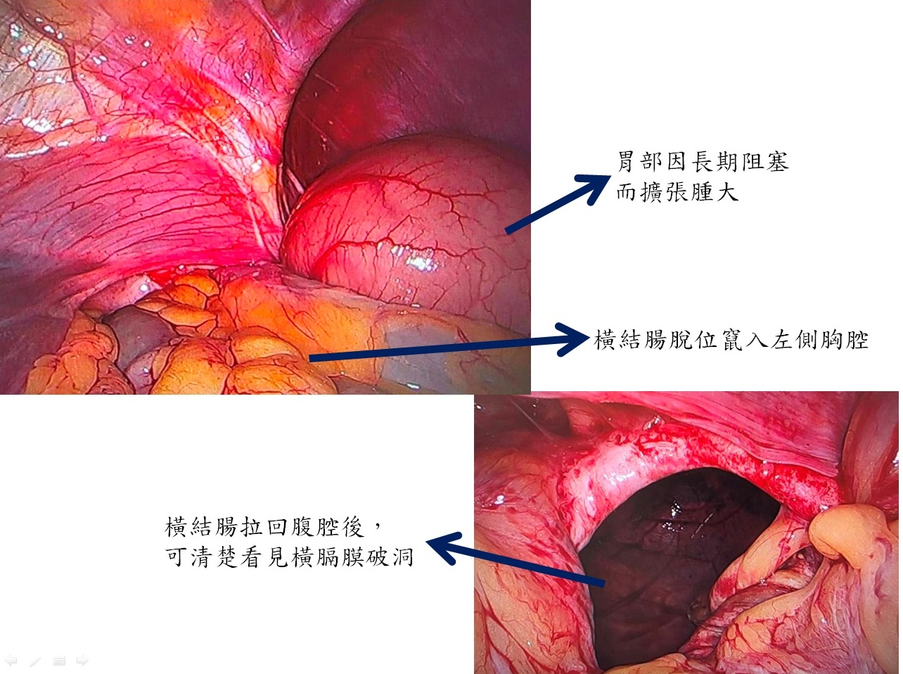 馮啟彥主任以腹腔鏡微創手術，將橫結腸拉回腹腔，並修補橫膈膜破洞。