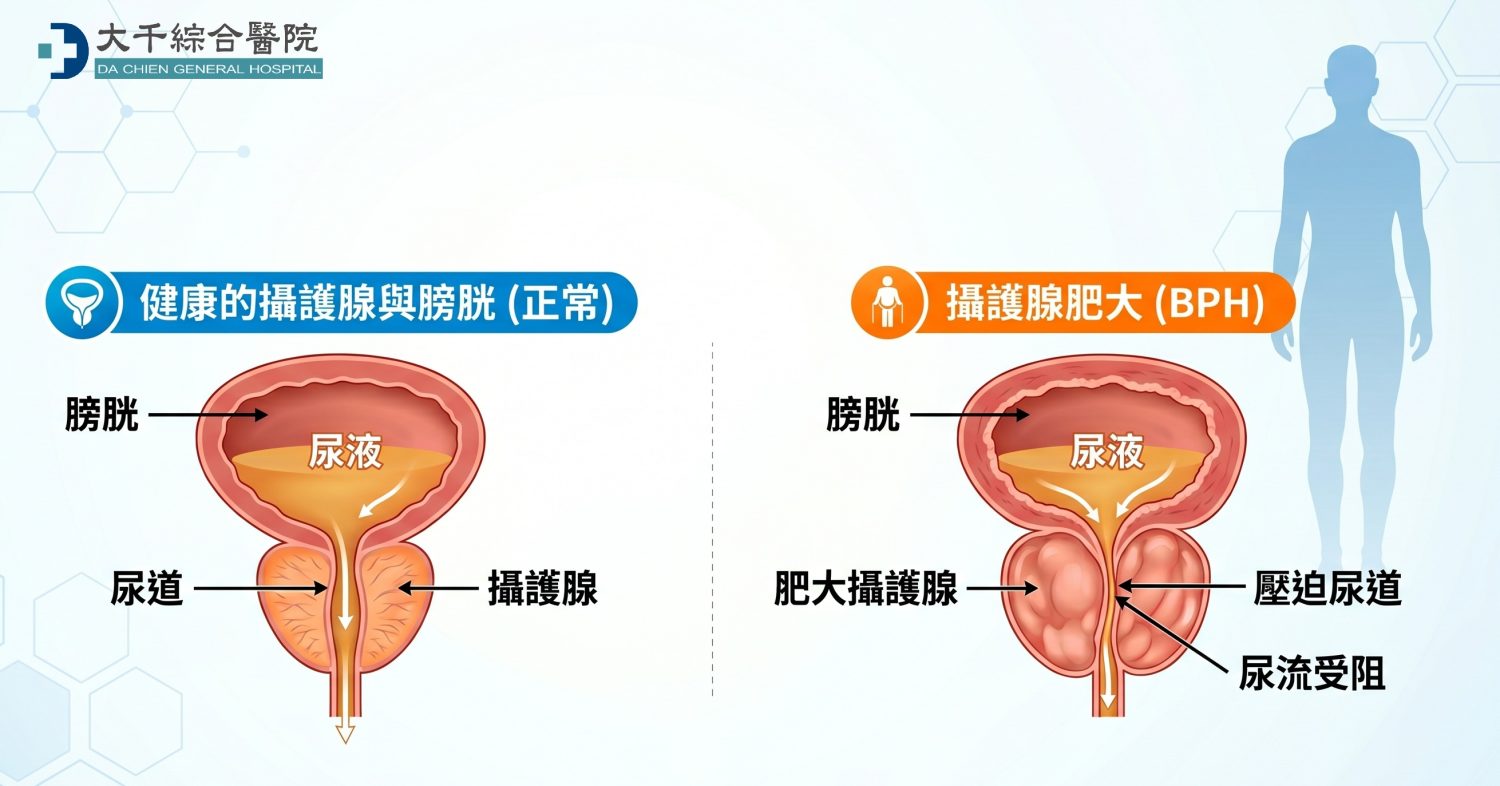楊立宇醫師強調，攝護腺肥大若置之不理，可能引發尿道感染、腎臟損傷，甚至無法排尿等問題。