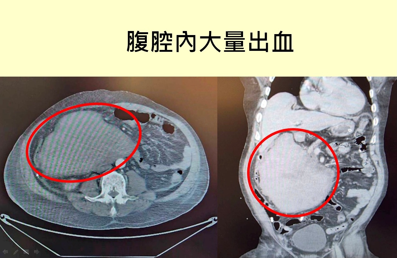 大千綜合醫院外科部主任馮啟彥主任表示，男子經檢查發現，腹腔內有大量出血(紅圈處)，導致休克狀態。（圖／大千醫院提供）
